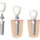 dental implants pretoria