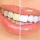 teeth whitening pretoria