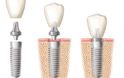 Why You Should Get Dental Implants (If You Need Them)