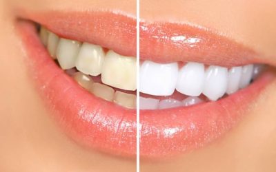 Teeth Whitening- Feel Confident