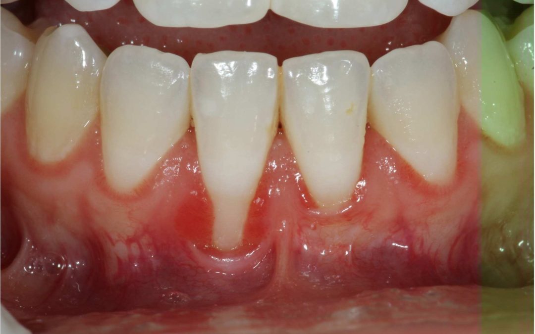 Combat Receding Gums: Understanding Causes and Treatment Options